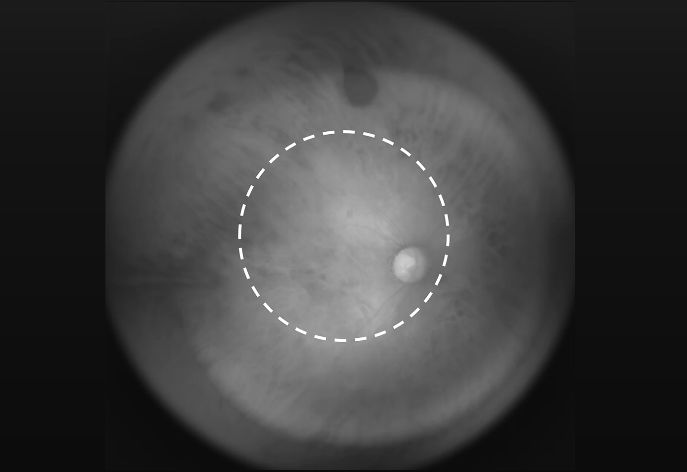 近赤外線による広角眼底像の撮影（一般的な眼底カメラの撮影範囲を点線で表示）
